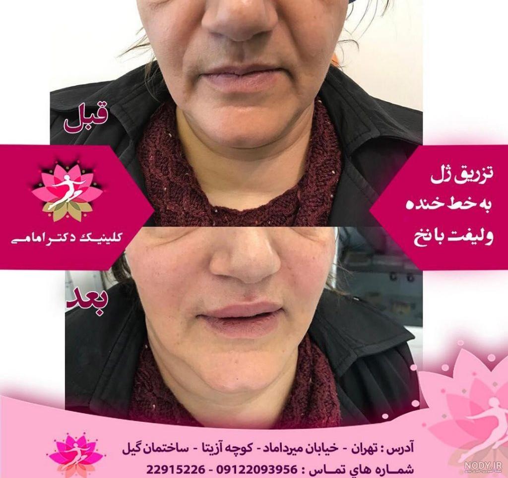 قیمت تزریق فیلر خط خنده در سال ۱۴۰۱ | فیلر خط خنده چیست | فیلم تزریق ژل خط خنده قیمت تزریق فیلر خط خنده در سال ۱۴۰۱ | فیلر خط خنده چیست | فیلم تزریق ژل خط خنده