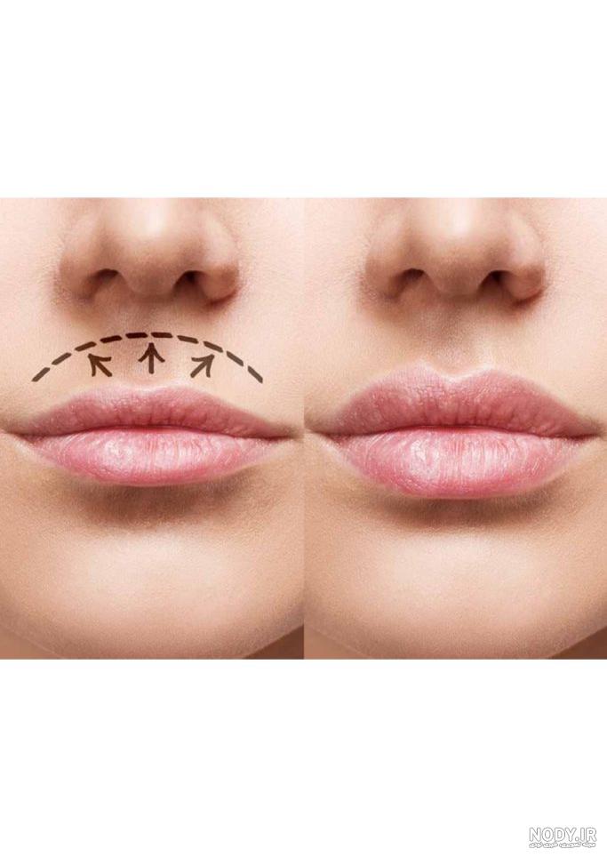 قیمت تزریق ژل لب روسی در اصفهان قیمت تزریق ژل لب روسی در اصفهان