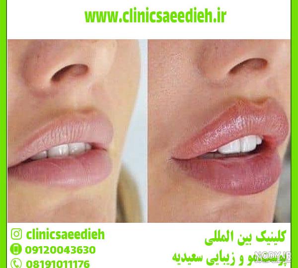 قیمت تزریق ژل لب روسی در شیراز قیمت تزریق ژل لب روسی در شیراز
