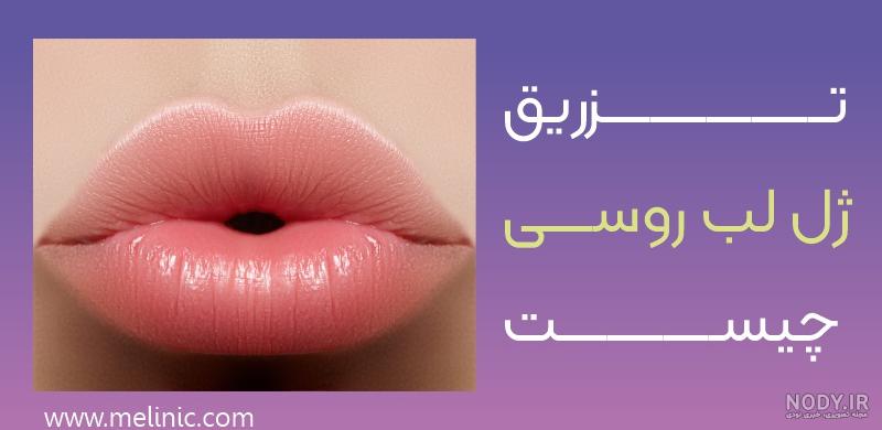 لب روسی (لب عروسکی) – دکتر سحر عماد مستوفی لب روسی (لب عروسکی) – دکتر سحر عماد مستوفی