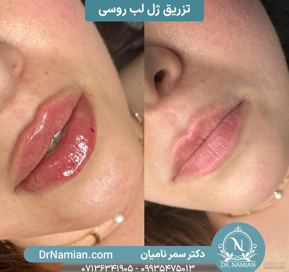 لب روسی (لب عروسکی) – دکتر سحر عماد مستوفی لب روسی (لب عروسکی) – دکتر سحر عماد مستوفی