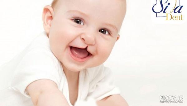 لب شکری (شکاف لب) چیست و چگونه درمان میشود؟ آیا میتوان از آن جلوگیری کرد؟