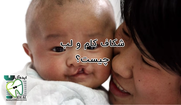لب شکری چیست؟ علل ایجاد کام شکافته در کودکان و راه تشخیص + 3 عوارض آن