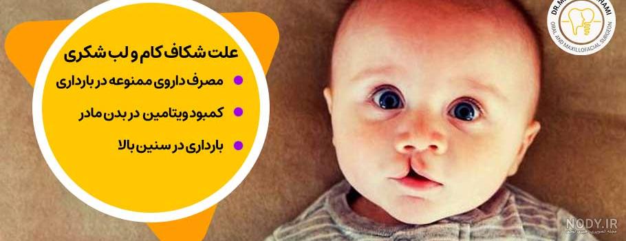 لب شکری یا شکاف لب چیست؟ راه های درمان لب شکری | پذیرش۲۴ لب شکری یا شکاف لب چیست؟ راه های درمان لب شکری | پذیرش۲۴