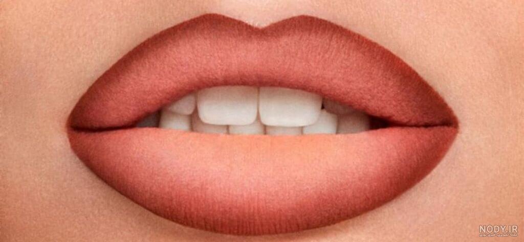 لب شکری یا شکاف لب چیست؟ راه های درمان لب شکری | پذیرش۲۴ لب شکری یا شکاف لب چیست؟ راه های درمان لب شکری | پذیرش۲۴