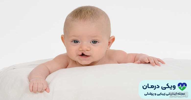 لب شکری یا شکاف کام و لب چیست؟ (انواع، علت، درمان) | توان درمان لب شکری یا شکاف کام و لب چیست؟ (انواع، علت، درمان) | توان درمان