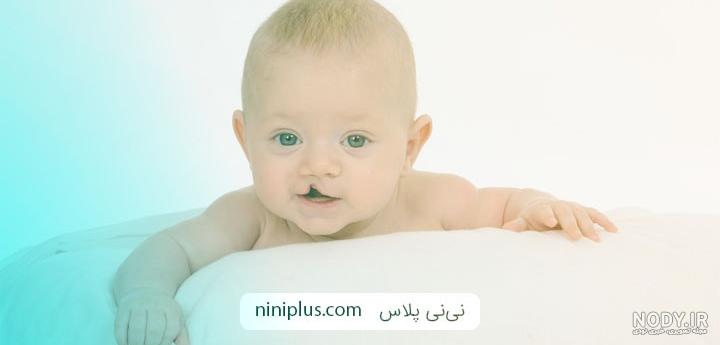 لب شکری یا شکاف کام و لب چیست؟ (انواع، علت، درمان) | توان درمان لب شکری یا شکاف کام و لب چیست؟ (انواع، علت، درمان) | توان درمان