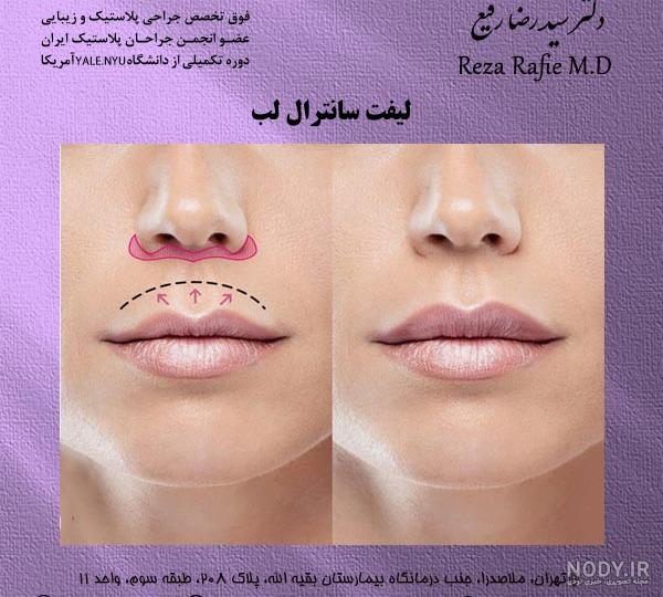 لیفت سانترال لب, جراحی بالا کشیدن لب, Central lip lift - کلینیک دکتر پاکدل | بهترین کلینیک زیبایی ایران و ترکیه لیفت سانترال لب, جراحی بالا کشیدن لب, Central lip lift - کلینیک دکتر پاکدل | بهترین کلینیک زیبایی ایران و ترکیه