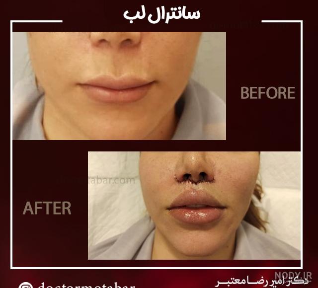 لیفت سانترال لب صفر تا صد + دکتر شیرزادگان لیفت سانترال لب صفر تا صد + دکتر شیرزادگان