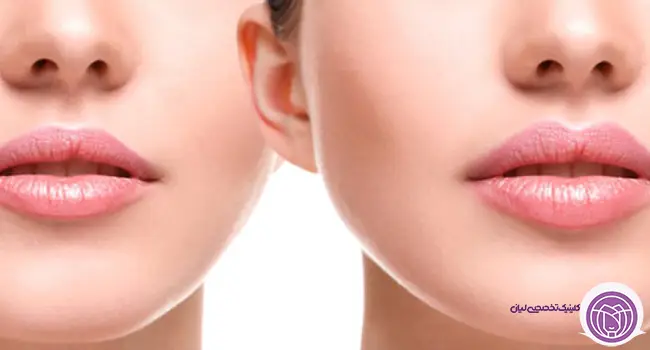 لیفت و سانترال لب در مشهد + هزینه عمل زیبایی لب لیفت و سانترال لب در مشهد + هزینه عمل زیبایی لب