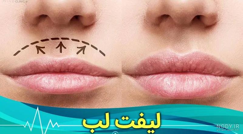 لیفت سانترال لب – دکتر هادی آمالی لیفت سانترال لب – دکتر هادی آمالی
