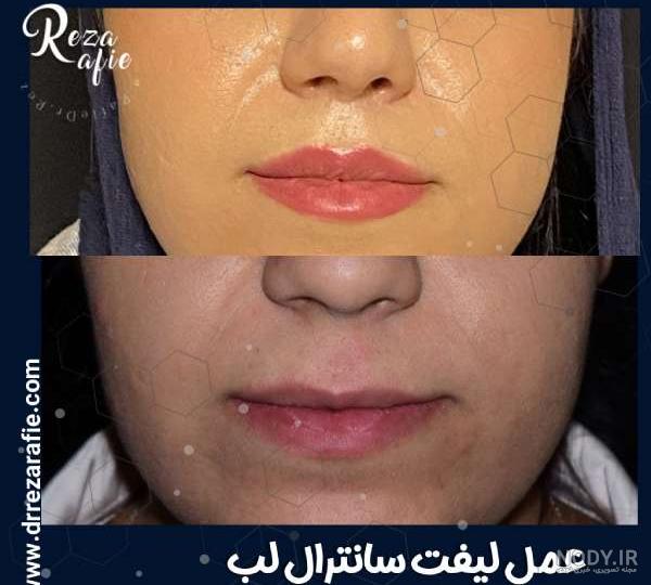 لیفت لب با بدون جراحی + عکس قبل و بعد ⋆ دکتر الناز احمدی لیفت لب با بدون جراحی + عکس قبل و بعد ⋆ دکتر الناز احمدی