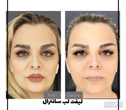لیفت لب چیست؟ لیفت سانترال لب، عوارض و قیمت | فایند کلینیک لیفت لب چیست؟ لیفت سانترال لب، عوارض و قیمت | فایند کلینیک
