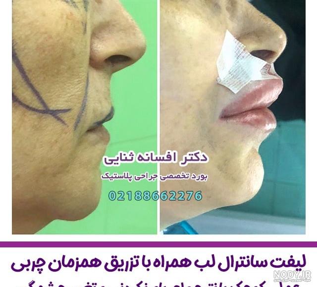 لیفت لب چیست؟ لیفت سانترال لب، عوارض و قیمت | فایند کلینیک لیفت لب چیست؟ لیفت سانترال لب، عوارض و قیمت | فایند کلینیک