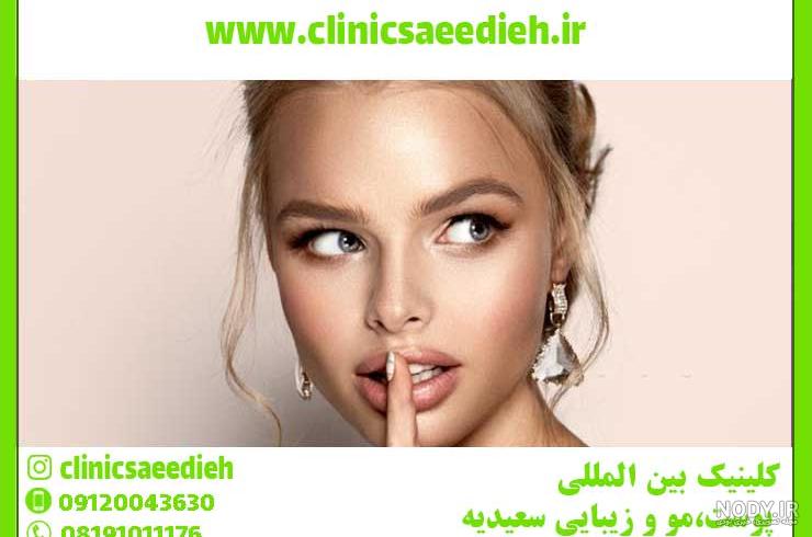 لیفت نخ لب ها به چه صورت می باشد ؟ - کلینیک هلیا لیفت نخ لب ها به چه صورت می باشد ؟ - کلینیک هلیا