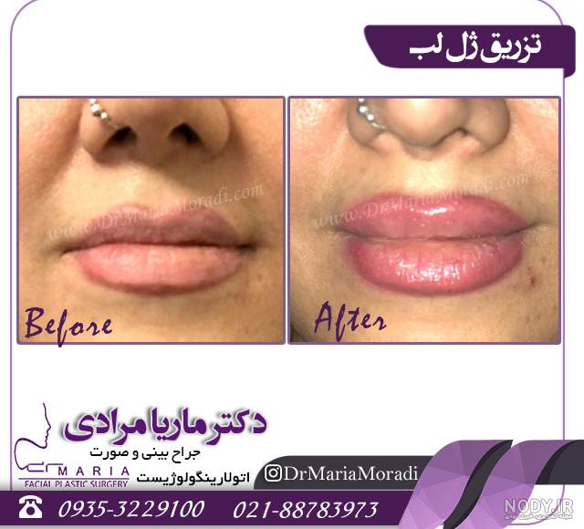 مدل ژل لب عروسکی و روسی + مدل های نچرال و قلوه ای