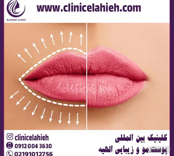 مدل ژل لب عروسکی چاکدار چیست و چگونه تزریق آن انجام می‌شود؟ - آی گل