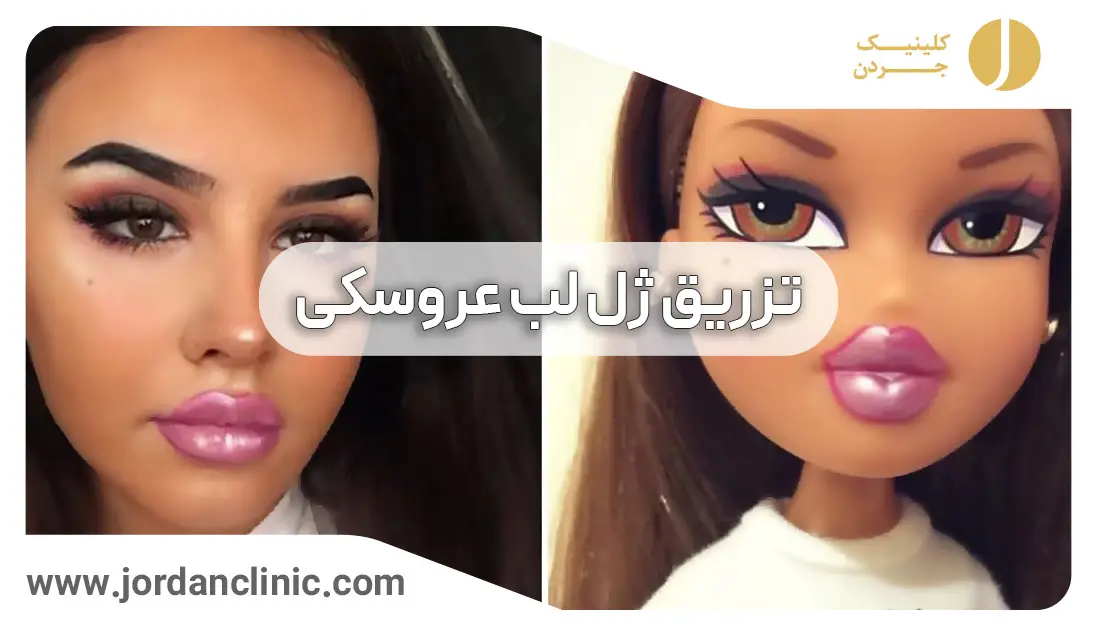 مرکز پروتز لب در شریعتی | پروتز لب باریک در کلینیک زیبایی و لاغری گل مریم مرکز پروتز لب در شریعتی | پروتز لب باریک در کلینیک زیبایی و لاغری گل مریم