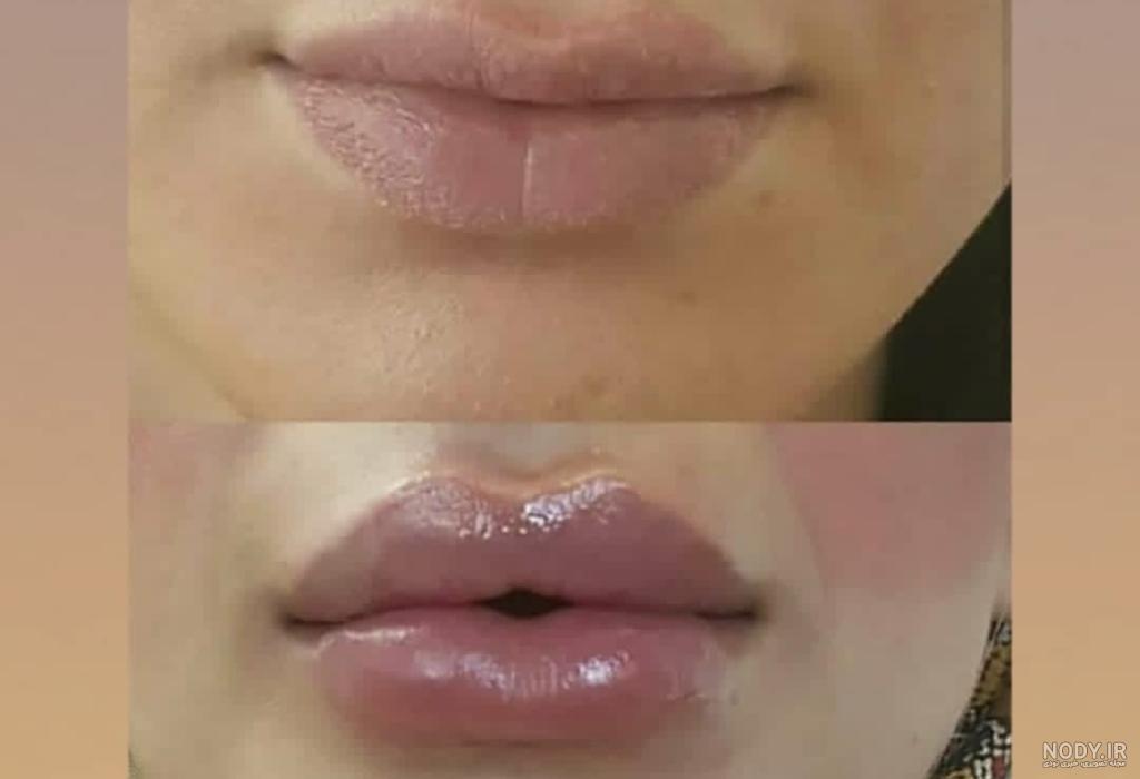 معرفی بهترین برندهای ژل جهت تزریق در صورت و لب معرفی بهترین برندهای ژل جهت تزریق در صورت و لب