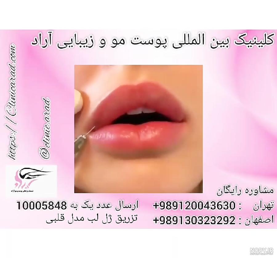 نحوه تزریق و ماندگاری ژل لب مدل قلبی نحوه تزریق و ماندگاری ژل لب مدل قلبی