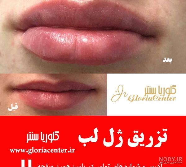 هزینه تزریق ژل لب در 1403 ✓ + فیلم و عکس ✔️ | مرکز زیبایی و لیزر
