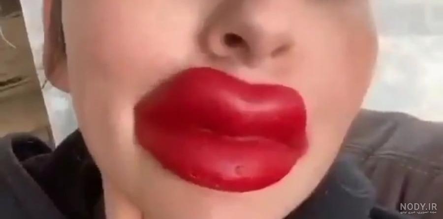 همه چیز در مورد تزریق ژل لب - کلینیک زیبای دکتر ترانه امامی همه چیز در مورد تزریق ژل لب - کلینیک زیبای دکتر ترانه امامی
