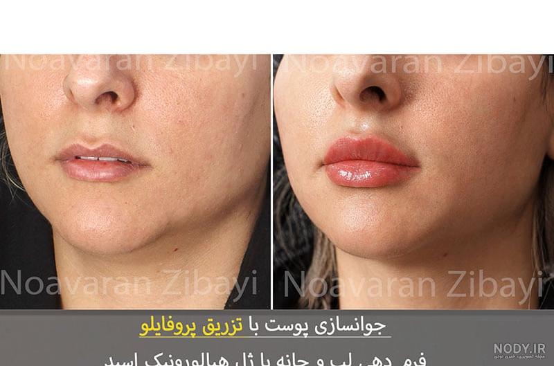 پروتز لب مدل عروسکی چیست؟ +مزایای و معایب پروتز لب مدل عروسکی چیست؟ +مزایای و معایب