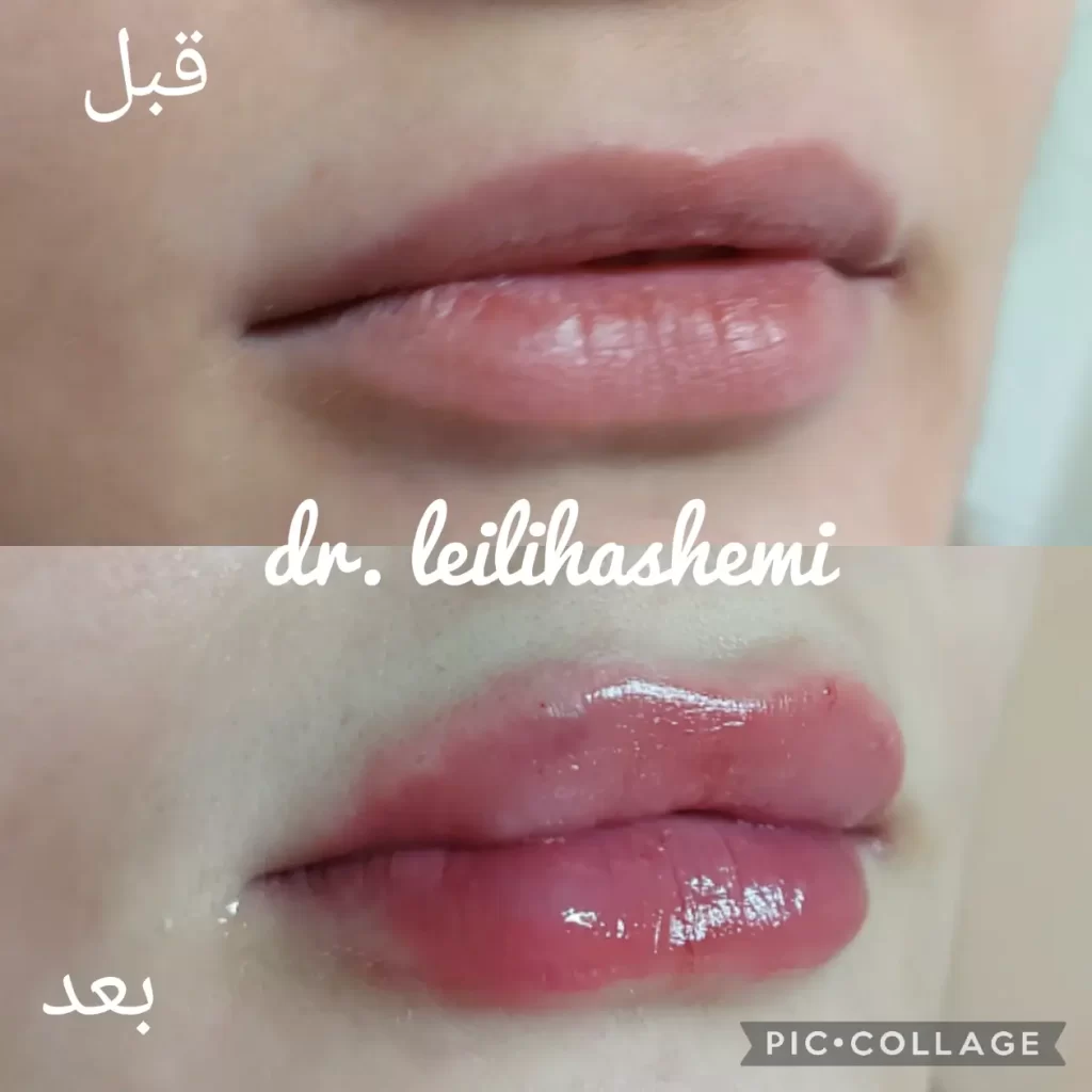 پروتز لب چگونه انجام می‌شود؟ عوارض پروتز لب | پذیرش۲۴