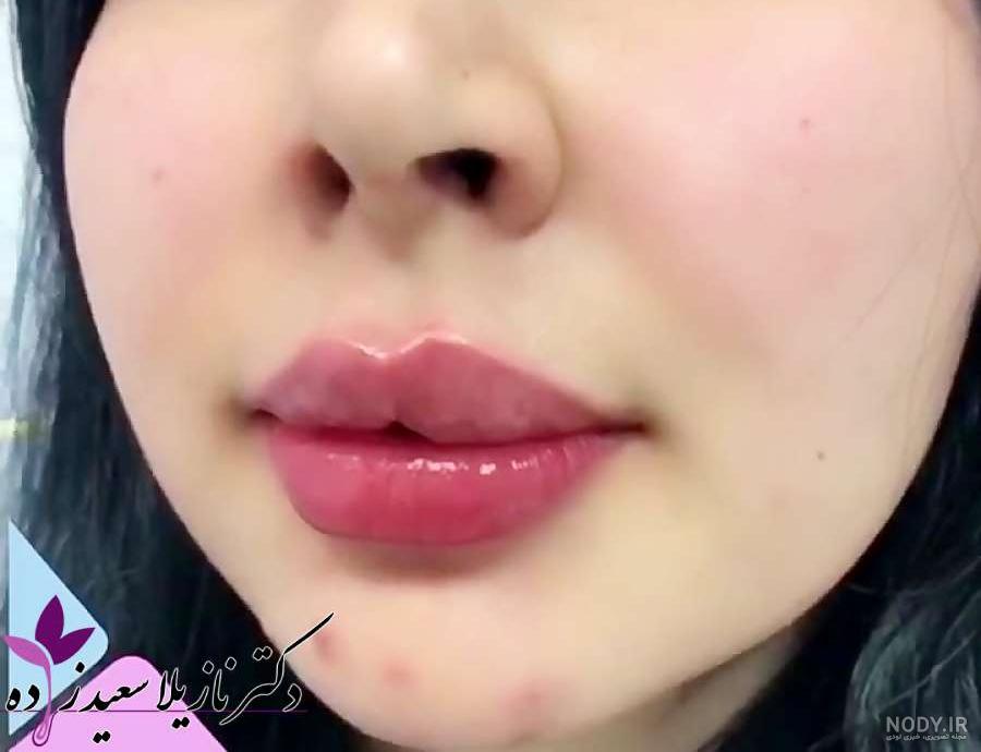 پروتز لب چگونه زده می شود؟ - انواع پروتز لب👄 کلینیک نوآوران زیبایی پروتز لب چگونه زده می شود؟ - انواع پروتز لب👄 کلینیک نوآوران زیبایی