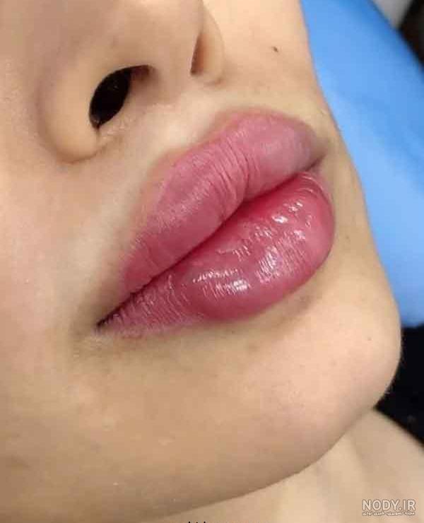 پروتز لب چیست؟ مراحل انجام عمل پروتز لب و میزان ماندگاری پروتز پروتز لب چیست؟ مراحل انجام عمل پروتز لب و میزان ماندگاری پروتز