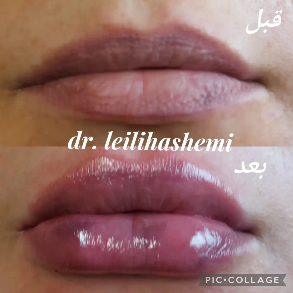 پروتز لب چیست؟ مراحل انجام عمل پروتز لب و میزان ماندگاری پروتز پروتز لب چیست؟ مراحل انجام عمل پروتز لب و میزان ماندگاری پروتز