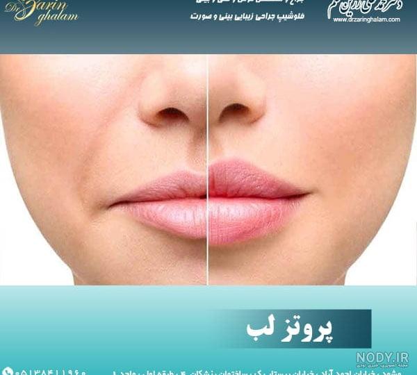 پروتز لب چیست؟ مراحل انجام عمل پروتز لب و میزان ماندگاری پروتز پروتز لب چیست؟ مراحل انجام عمل پروتز لب و میزان ماندگاری پروتز