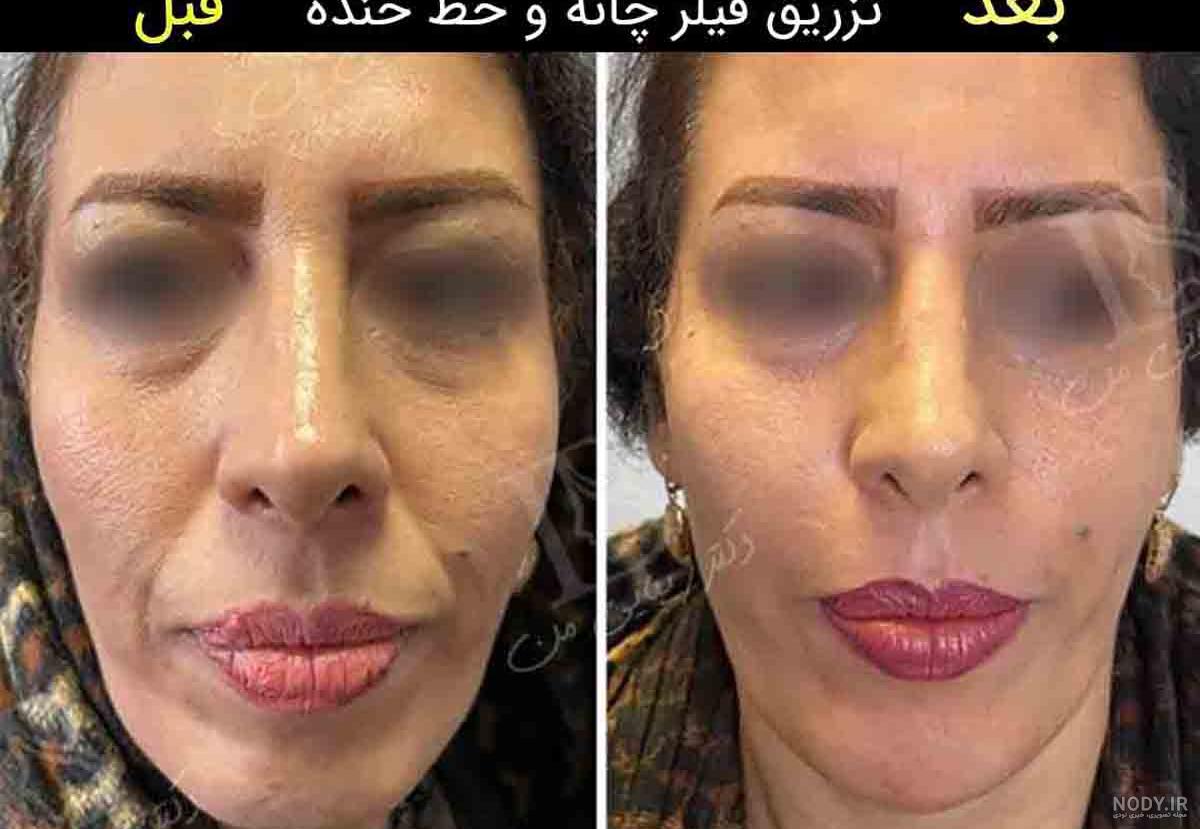 ژل خط خنده چیست؟ | بهترین مارک فیلر خط خنده | عوارض فیلر خط خنده + قیمت ژل خط خنده چیست؟ | بهترین مارک فیلر خط خنده | عوارض فیلر خط خنده + قیمت