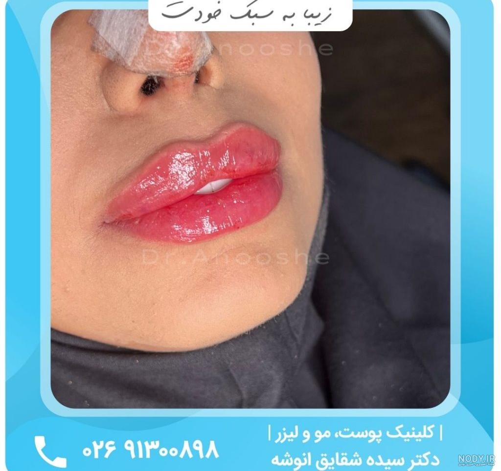 ژل لب روسی + عکس و فیلم برجسته سازی لب