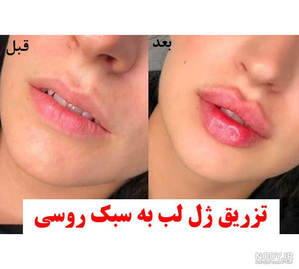 ژل لب روسی: نحوه تزریق، عکس ژل روسی، قیمت و عوارض – مجله سلامت دکترتو ژل لب روسی: نحوه تزریق، عکس ژل روسی، قیمت و عوارض – مجله سلامت دکترتو