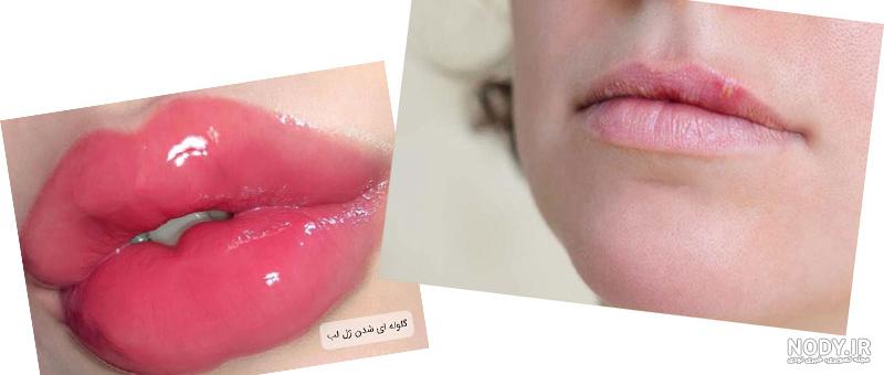 ژل لب روسی: نحوه تزریق، عکس ژل روسی، قیمت و عوارض – مجله سلامت دکترتو ژل لب روسی: نحوه تزریق، عکس ژل روسی، قیمت و عوارض – مجله سلامت دکترتو