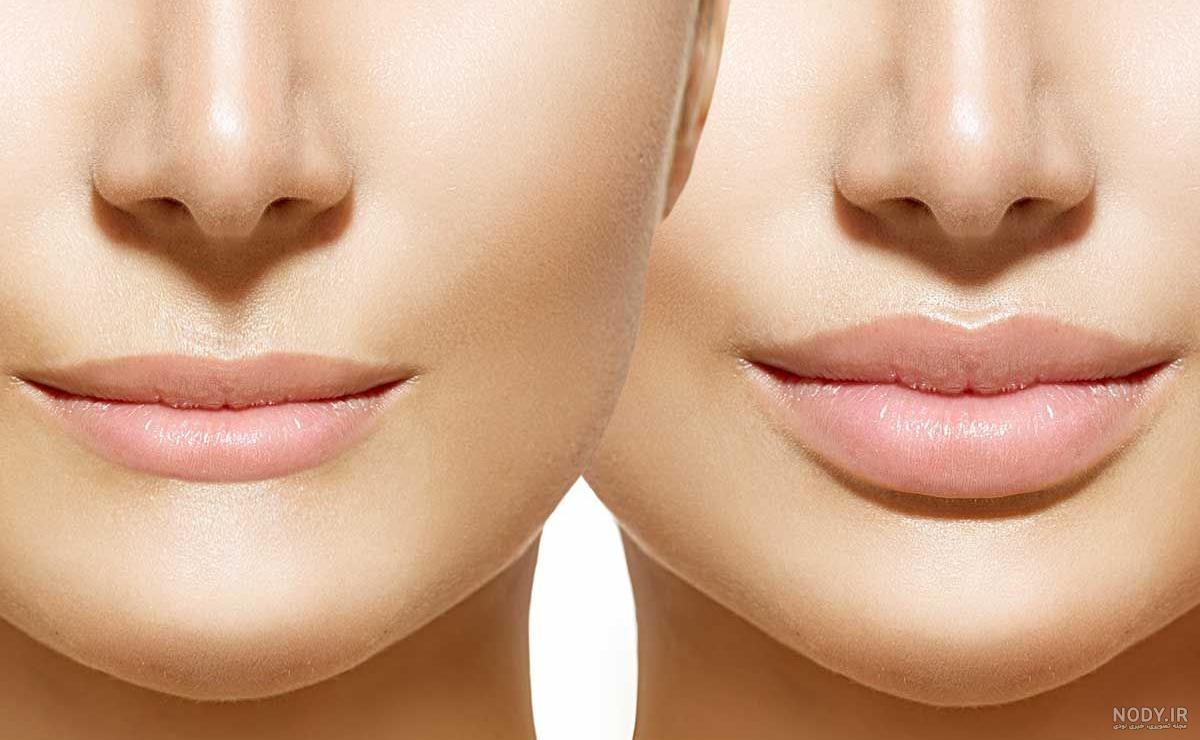 ژل لب روسی: نحوه تزریق، عکس ژل روسی، قیمت و عوارض – مجله سلامت دکترتو ژل لب روسی: نحوه تزریق، عکس ژل روسی، قیمت و عوارض – مجله سلامت دکترتو