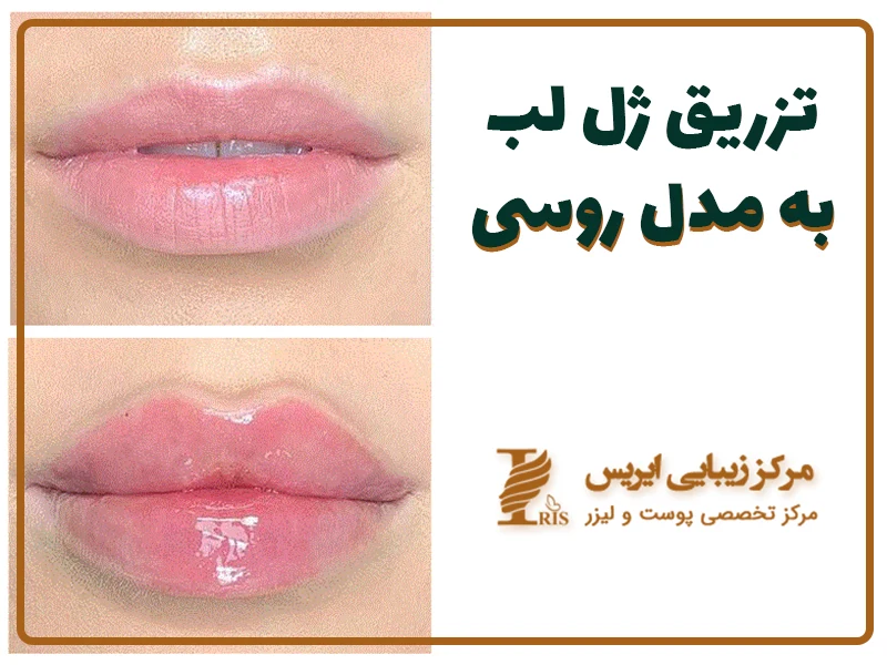 ژل لب روسی چیست | قیمت، مزایا، مراقبت ها ✌️ - دکتر غزال یزدانی ژل لب روسی چیست | قیمت، مزایا، مراقبت ها ✌️ - دکتر غزال یزدانی