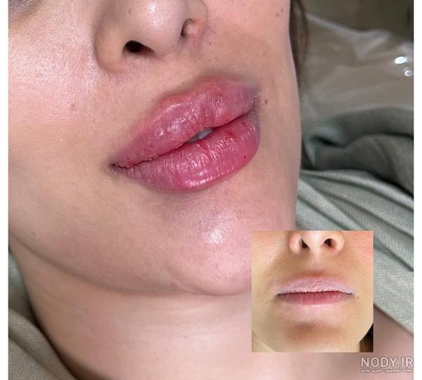 ژل لب عروسکی و باربی برای چه صورت هایی مناسب است؟ قیمت و عوارض آن چیست؟