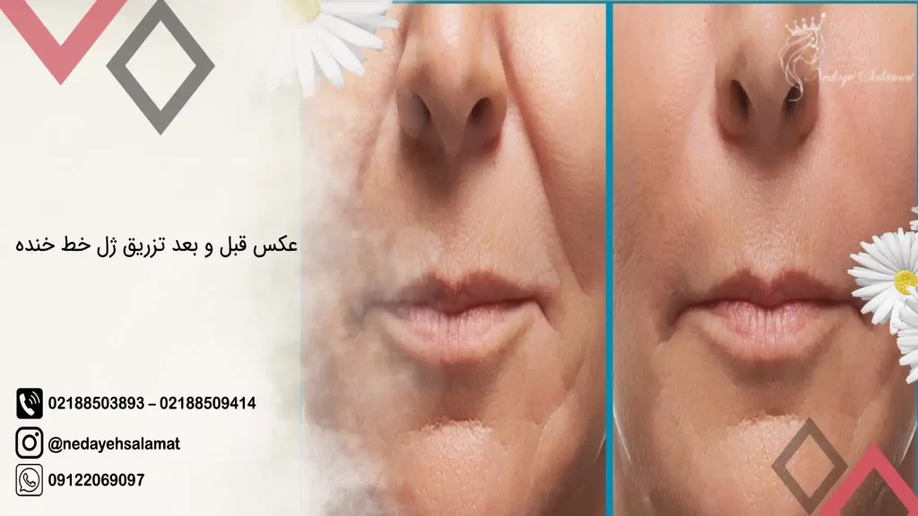 ژل لب عروسکی: تزریق ژل لب مدل عروسکی، قیمت+ فیلم — مجله زیبایی لیا ژل لب عروسکی: تزریق ژل لب مدل عروسکی، قیمت+ فیلم — مجله زیبایی لیا