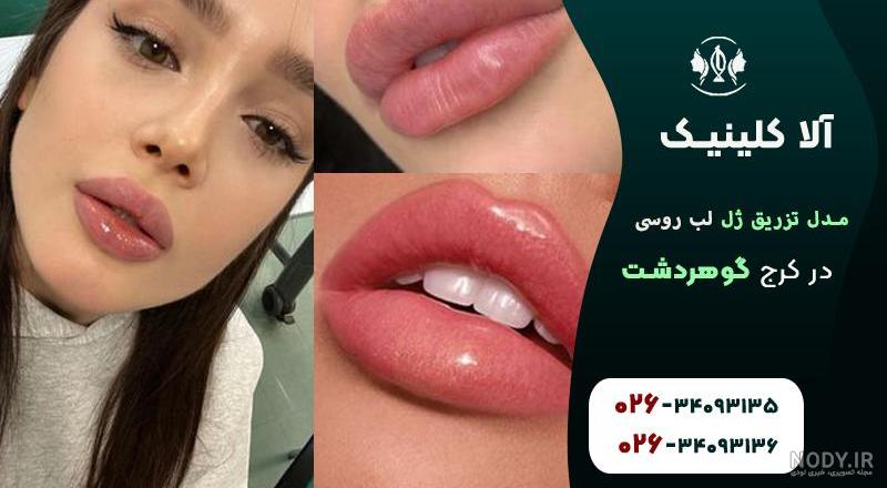 ژل لب عروسکی: تزریق ژل لب مدل عروسکی، قیمت+ فیلم — مجله زیبایی لیا