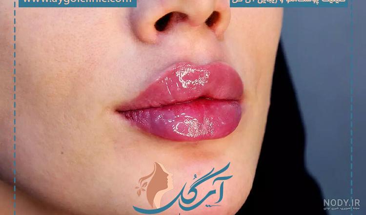 ژل لب عروسکی: تزریق ژل لب مدل عروسکی، قیمت+ فیلم — مجله زیبایی لیا