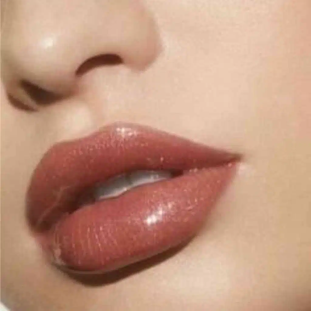 ژل لب قلوه ای: هزینه، مزایا و عوارض تزریق ژل لب مدل قلوه ای ژل لب قلوه ای: هزینه، مزایا و عوارض تزریق ژل لب مدل قلوه ای