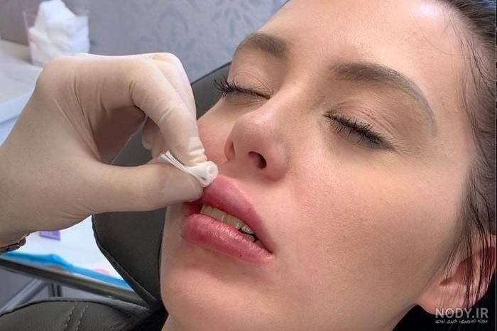 ژل لب مدل روسی: تکنیک تزریق ژل لب مدل روسی، زیباترین مدل های لب با تزریق ژل ژل لب مدل روسی: تکنیک تزریق ژل لب مدل روسی، زیباترین مدل های لب با تزریق ژل