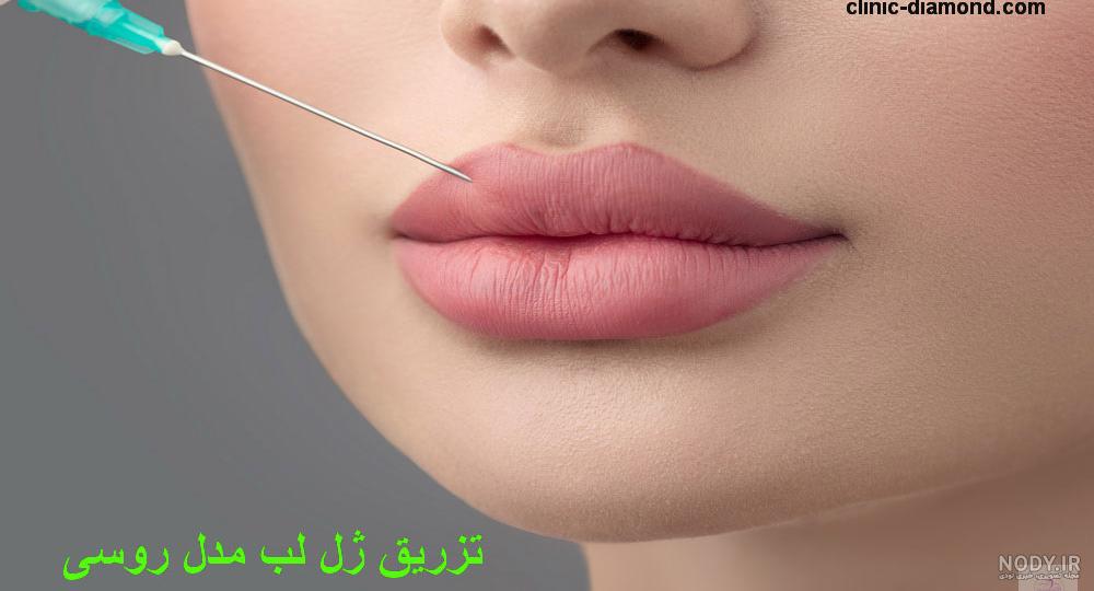 ژل لب مدل روسی: مزایا و نحوه تزریق ژل لب با متد روسی - منشور زیبایی و سلامت پوست ژل لب مدل روسی: مزایا و نحوه تزریق ژل لب با متد روسی - منشور زیبایی و سلامت پوست