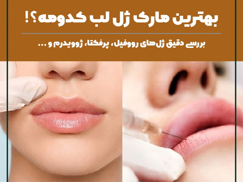 ژل لب کره ای رووفیل ✓ + فیلم و عکس ✔️ | مرکز زیبایی و لیزر ژل لب کره ای رووفیل ✓ + فیلم و عکس ✔️ | مرکز زیبایی و لیزر