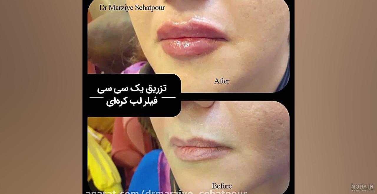 ژل لب کره ای رووفیل ✓ + فیلم و عکس ✔️ | مرکز زیبایی و لیزر ژل لب کره ای رووفیل ✓ + فیلم و عکس ✔️ | مرکز زیبایی و لیزر