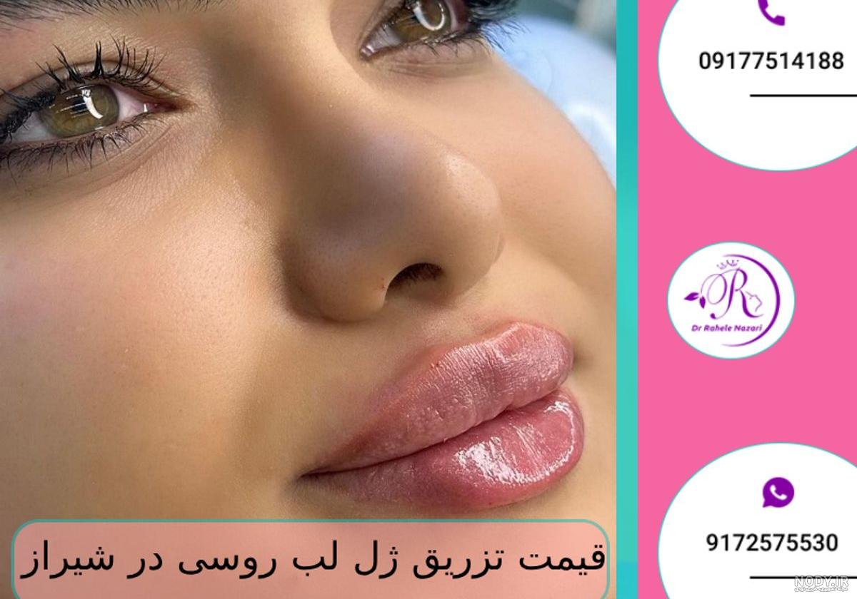 ژل لب کره ای و معرفی بهترین برند های ژل لب | کلینیک زیبایی مهراز ژل لب کره ای و معرفی بهترین برند های ژل لب | کلینیک زیبایی مهراز