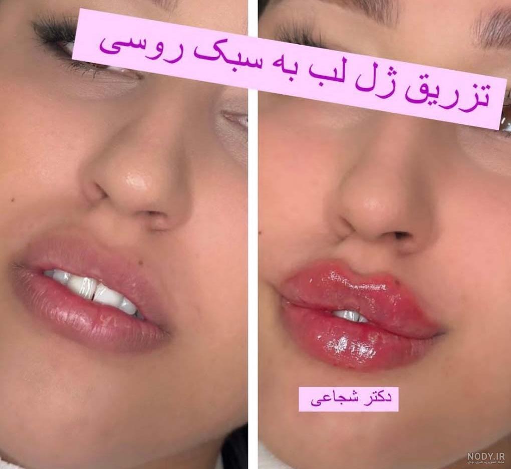 ژل لب کره ای و معرفی بهترین برند های ژل لب | کلینیک زیبایی مهراز ژل لب کره ای و معرفی بهترین برند های ژل لب | کلینیک زیبایی مهراز