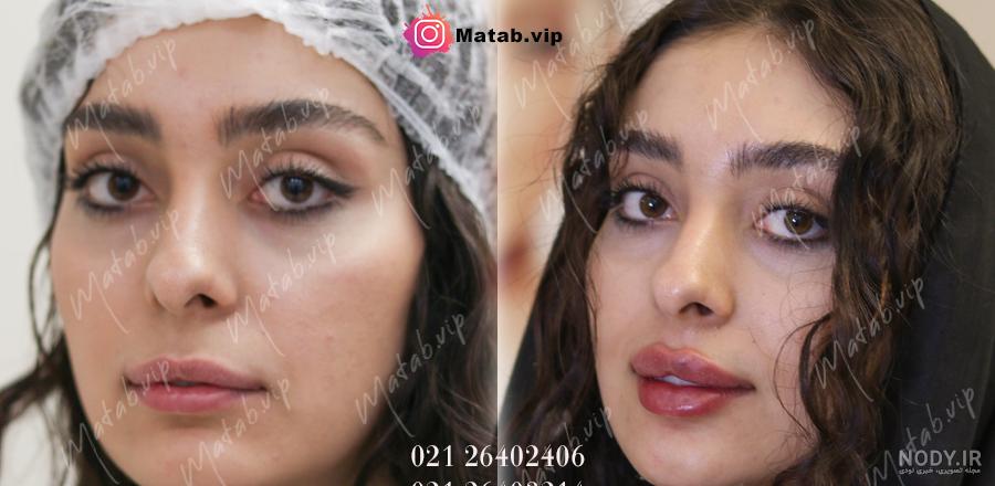 ژل لب کره‌ ای چیست و چگونه تزریق می‌شود؟ کلینیک زیبایی اسکین ناین